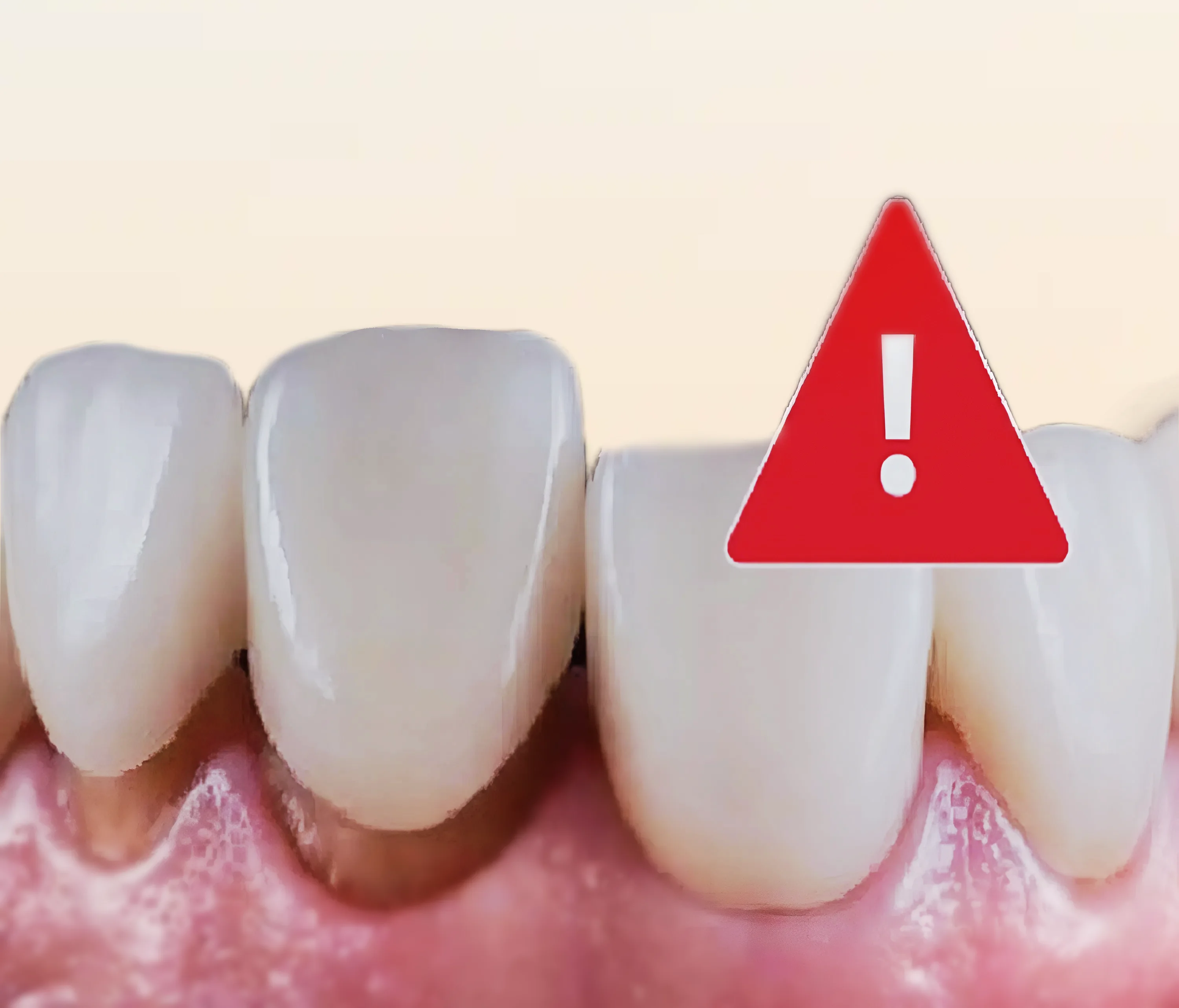 Nguyên nhân phổ biến nhất khiến răng sứ bị hỏng thường đến từ cùi răng thật